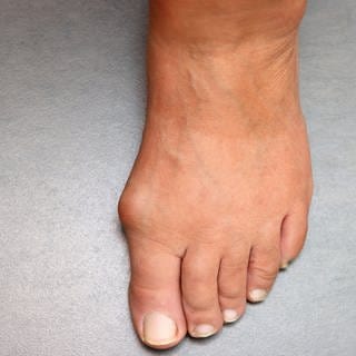 Hallux valgus