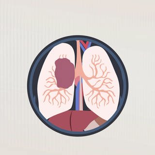 Schema Lungenkrebs
