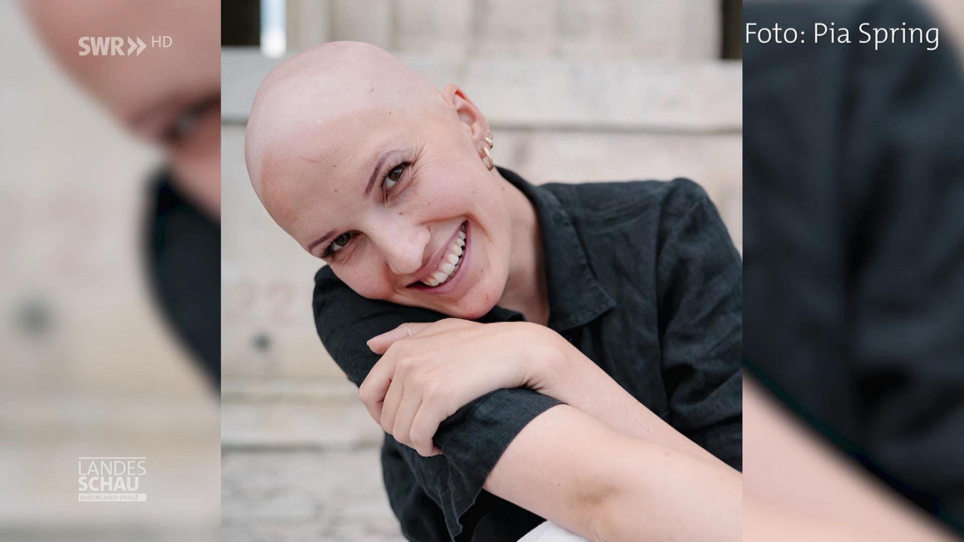 Sunniva Ferri macht auf Alopezie in den sozialen Medien aufmerksam