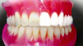 Beim Bleaching werden mittels Chemie Zähne weißer