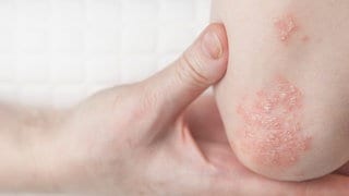 Schuppenflechte, auch Psoriasis genannt, ist eine Autoimmunerkrankung