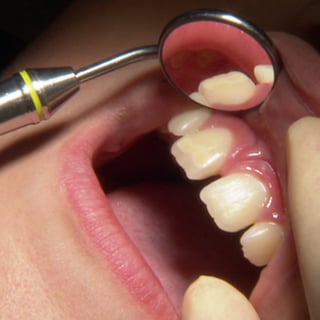 geöffneter Mund beim Zahnarzt