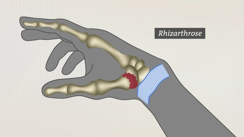 Rhizarthrose: Hier verursacht das Daumensattelgelenk Schmerzen in der Hand