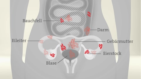 Chronische Krankheit Endometriose: Zellen, die denen der Gebärmutterschleimhaut (Endometrium) ähneln, siedeln sich außerhalb der Gebärmutter an 