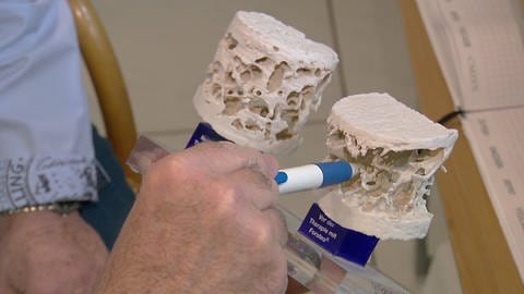 Arzt demonstriert Knochenschwund. Intakte Knochesubstanz neben porösem Exponat