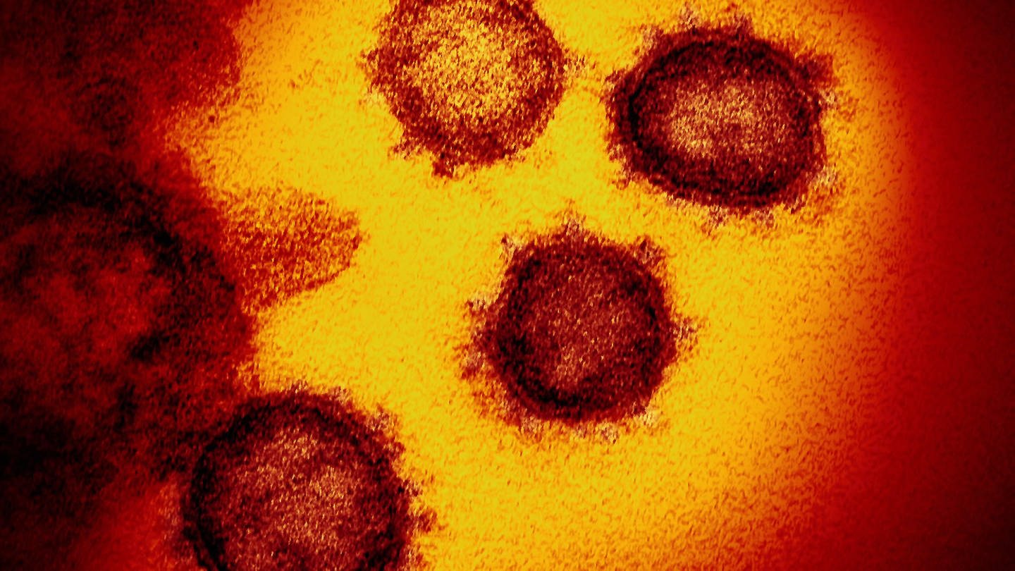 Coronavirus - Darstellung mit Elektronenrastermikroskop, Präparat rot-gelb dargestellt