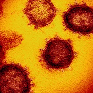 Coronavirus - Darstellung mit Elektronenrastermikroskop, Präparat rot-gelb dargestellt