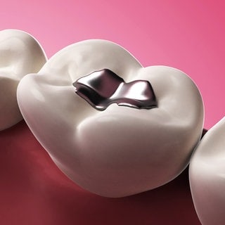 Gut zu wissen: EU-Verbot von Dentalamalgam