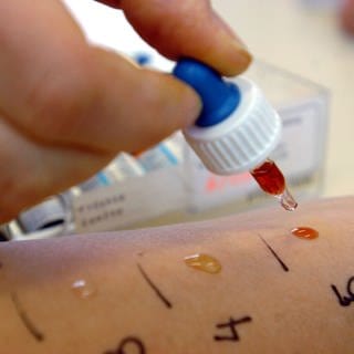 Bei einem Allergie-Test werden Substanzen auf die Haut einer Patientin aufgetragen.