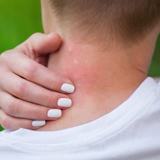 Frau kratzt sich an Mückenstichen im Nacken