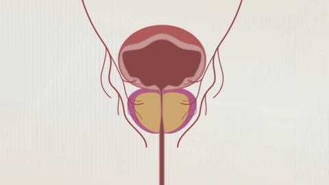 Schaubild einer vergrößerten Prostata mit verengter Harnröhre. Gutartige Prostatavergrößerung: So kann man sie behandeln.