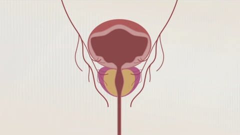 Schaubild einer normalen Prostata mit offenem Harngang. Gutartige Prostatavergrößerung: So kann man sie behandeln