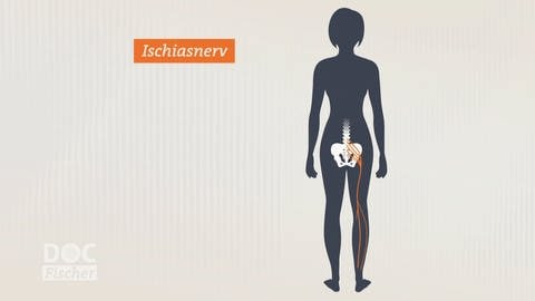 Grafik Ischiasnerv - Schmerzen am Rücken