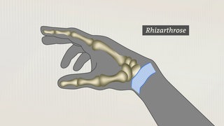 Grafik Rhizarthrose