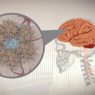 Abbildung des Gehirns - was passiert bei Alzheimer und welche Erfolge sprechen neue Medikamente?