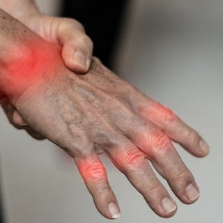 Ein älterer Mensch mit Gicht streckt seine Hand aus. Die durch einen Gichtanfall schmerzenden Gelenke sind rot markiert. Gichtknoten sind noch keine zu sehen.