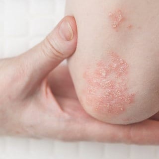 Ellenbogen mit rötlicher Schuppenflechte. Was hilft bei Psoriasis und Psoriasis Arthritis?