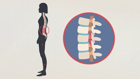 Die Graphik zeigt einen Menschen im Querschnitt, die Wirbelsäule ist farblich hervorgehoben. Im Lendenwirbelbereich ist sie rot gefarbt, dort wo die Rückenschmerzen am stärksten sind. Rechts davon zeigt eine Blase einen vergrößerten Ausschnitt der Wirbelsäule, hier wird der verengte Wirbelkanal mit den eingklemmten Nerven des Rückenmarks besonders deutlich.