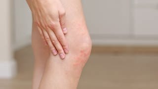 Eine Hand krazt sich am Knie: Ein geröteter, fleckiger Hautausschlag ist zu sehen. Es handelt sich um Nesselsucht.