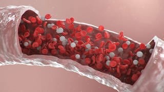 Grafik einer Gefäßverengung mit Thrombozyten und Cholesterin - Bei Arteriosklerose bleiben Gefäßverkalkungen lange unbemerkt. Gefährliche Folgen: Herzinfarkt und Schlaganfall. Das Risiko lässt sich senken und vorbeugen, auch ohne Medikamente.