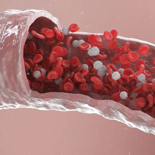 Grafik einer Gefäßverengung mit Thrombozyten und Cholesterin - Bei Arteriosklerose bleiben Gefäßverkalkungen lange unbemerkt. Gefährliche Folgen: Herzinfarkt und Schlaganfall. Das Risiko lässt sich senken und vorbeugen, auch ohne Medikamente.