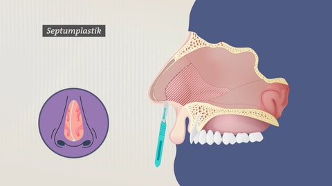 Grafische Darstellungs der Operation der Nasenscheidewand. 