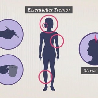 Erklärungsgrafik zum Essentielen Tremor